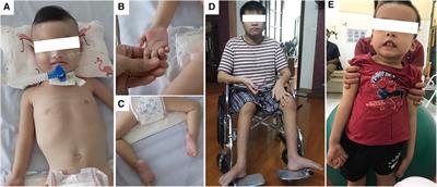 A novel IGHMBP2 variant and clinical diversity in Vietnamese SMARD1 and CMT2S patients